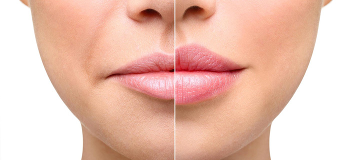 تکنیک‌های تزریق و تأثیر آن‌ها بر میزان ژل