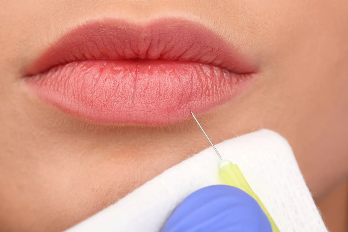 حجم دهی چه مقدار ژل لب تزریق کنم؟