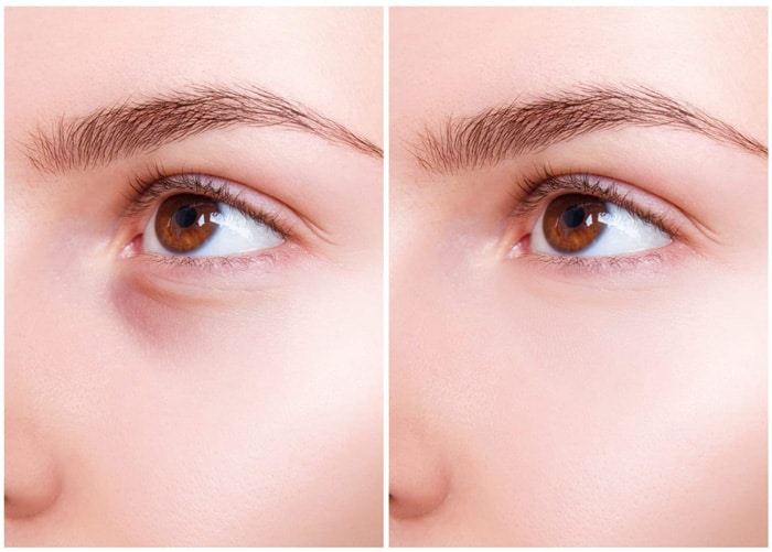 آیا مزوتراپی بعد از کاشت ابرو عوارضی دارد؟