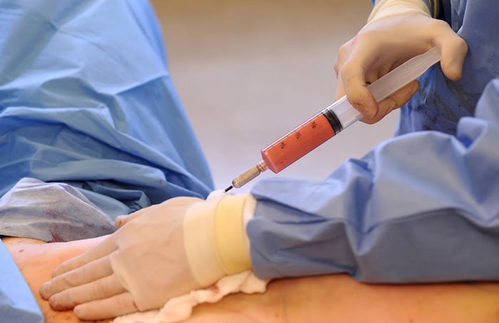 فیلر باسن چقدر ماندگاری دارد؟