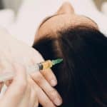 سوختگی بعد از میکرونیدلینگ مو
